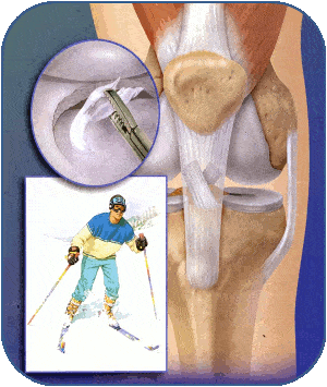 Copertina artroscopia di ginocchio